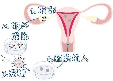 试管代孕费用多少